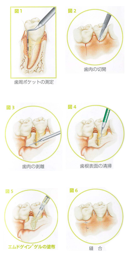 歯周外科処置　画像加工